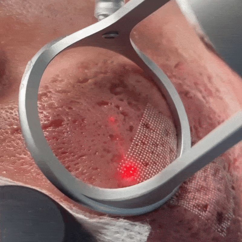 Clinical Acne Scar Repair Stick™